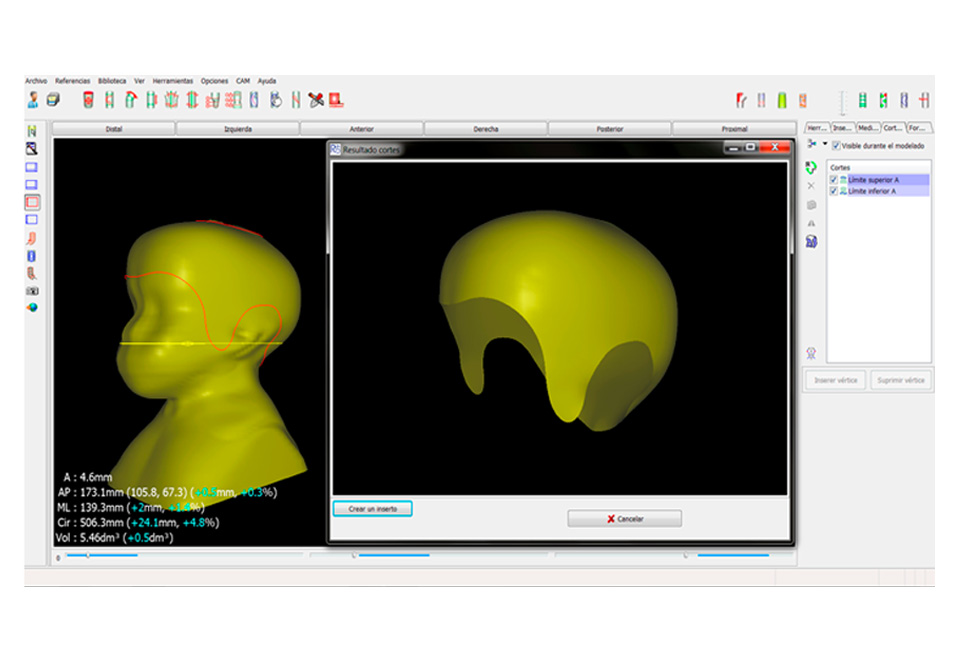 Ortesis craneal en base a imágenes hechas con escáner 3D